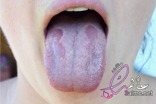 5 علاجات طبيعية لفطار الفم