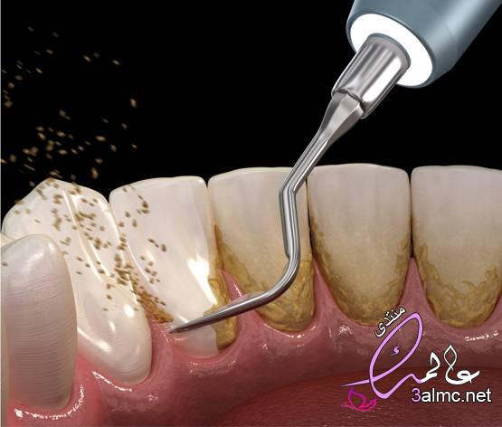 اضرار تنظيف الاسنان عند الطبيب| 9 نصائح بعد تنظيف الاسنان من الجير